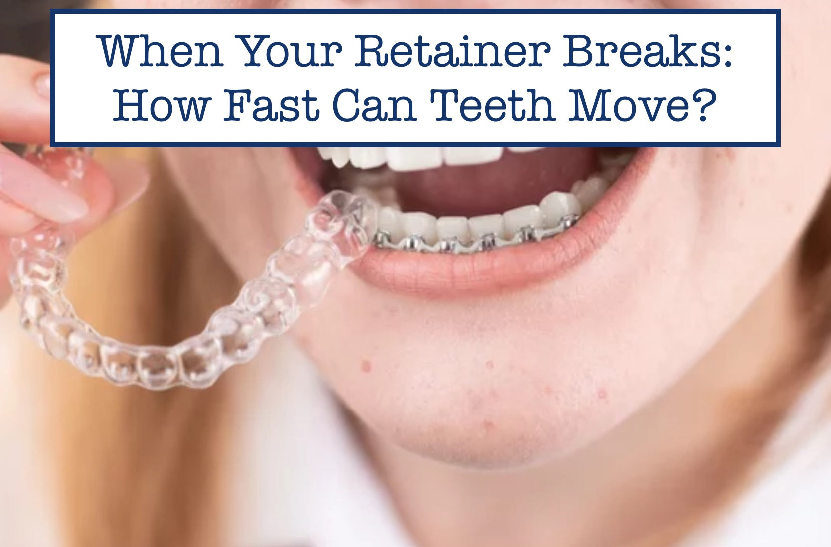 When Your Retainer Breaks: How Fast Can Teeth Move?