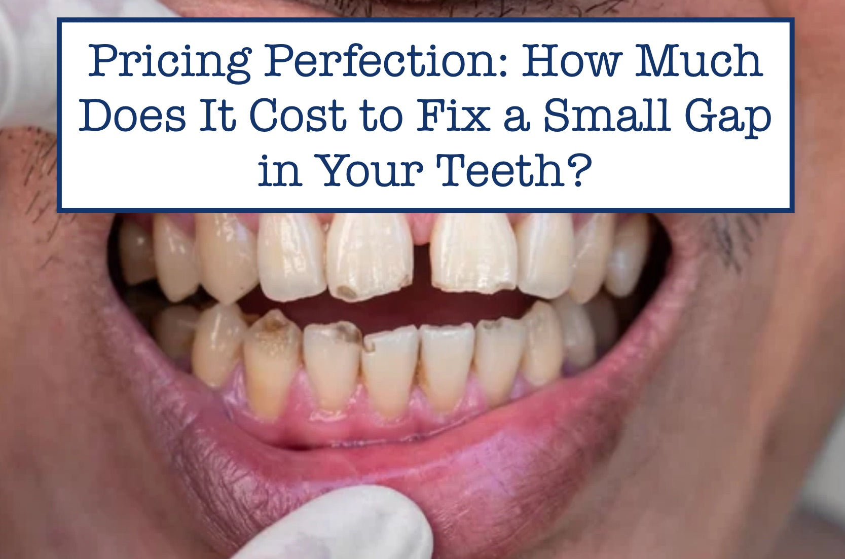 Pricing Perfection: How Much Does It Cost to Fix a Small Gap in Your Teeth?