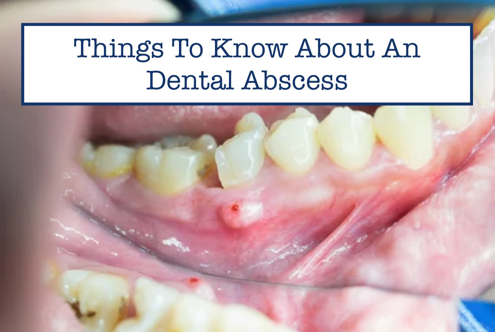 Things To Know About An Dental Abscess