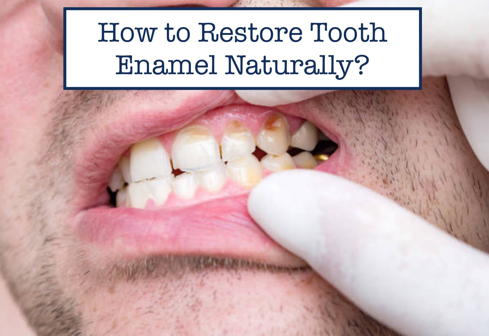 How Do Dentists Restore Enamel at Sam Moonlight blog