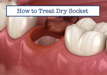 How to Treat Dry Socket
