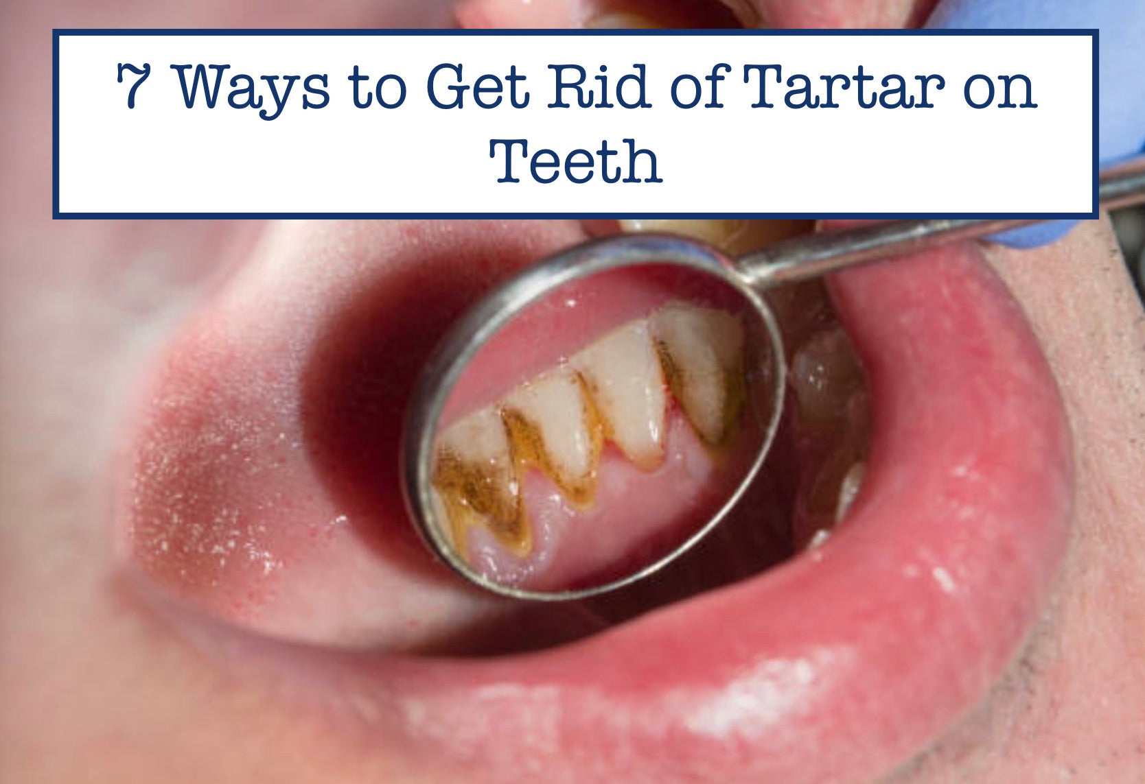 7 Ways To Get Rid Of Tartar On Teeth
