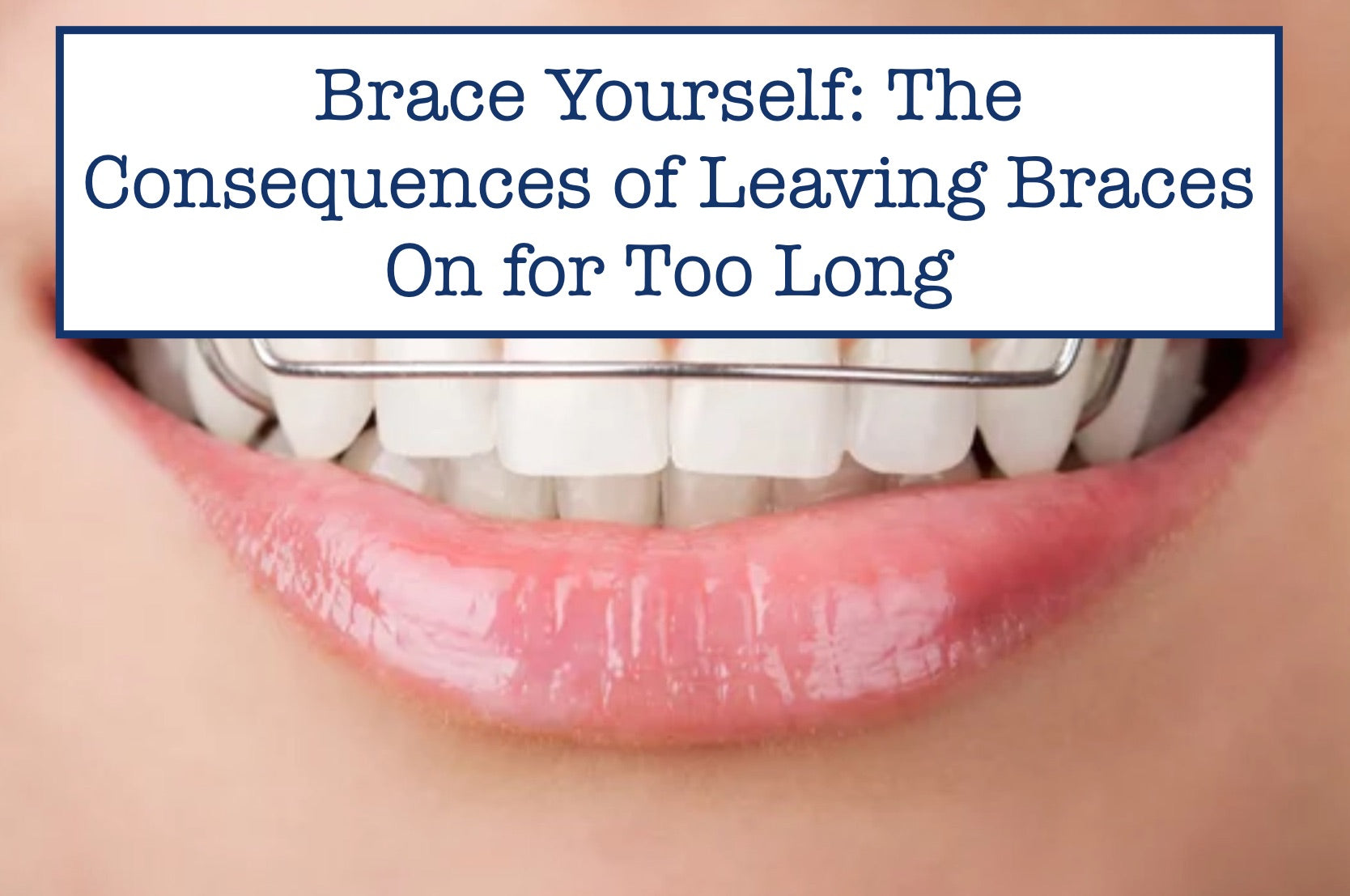 Brace Yourself: The Consequences of Leaving Braces On for Too Long