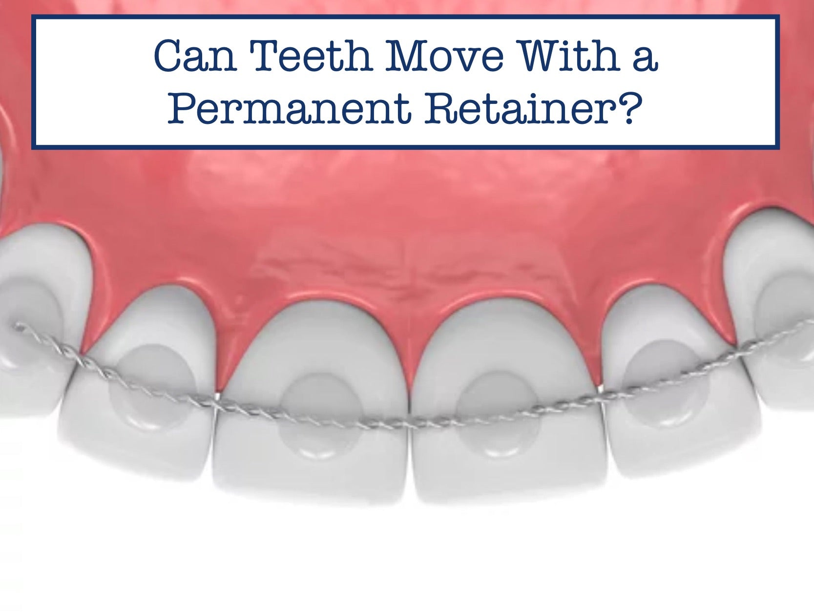 Can Teeth Move With a Permanent Retainer?
