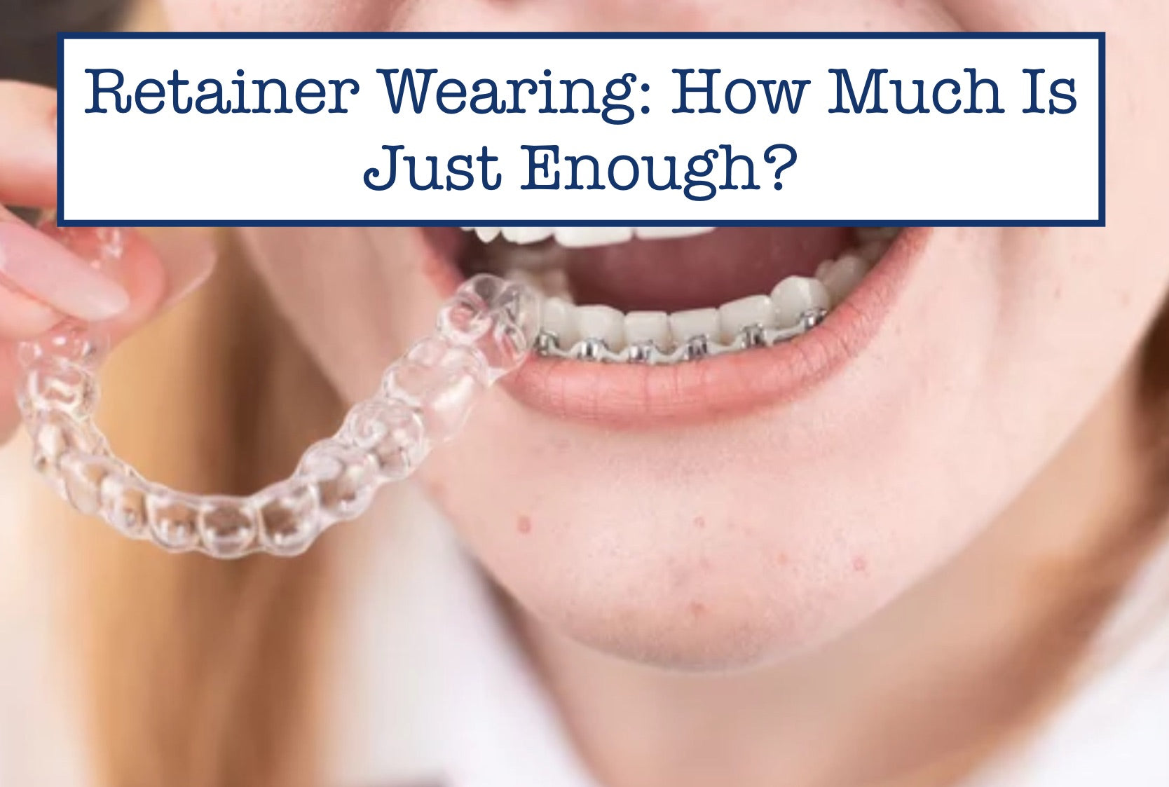 Retainer Wearing: How Much Is Just Enough? – B.WEISS Health