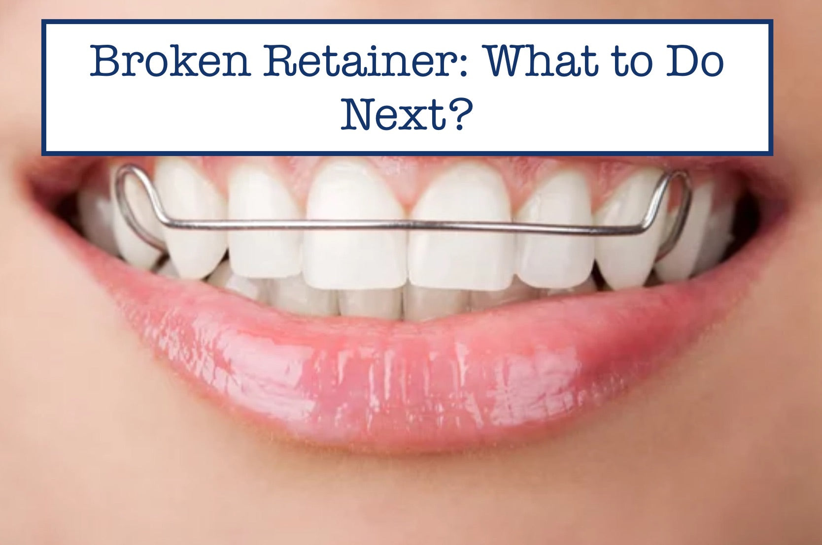 Fixed Retainer Problems Broken Retainer: What to Do Next?