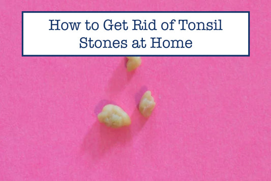 How to Get Rid of Tonsil Stones at Home