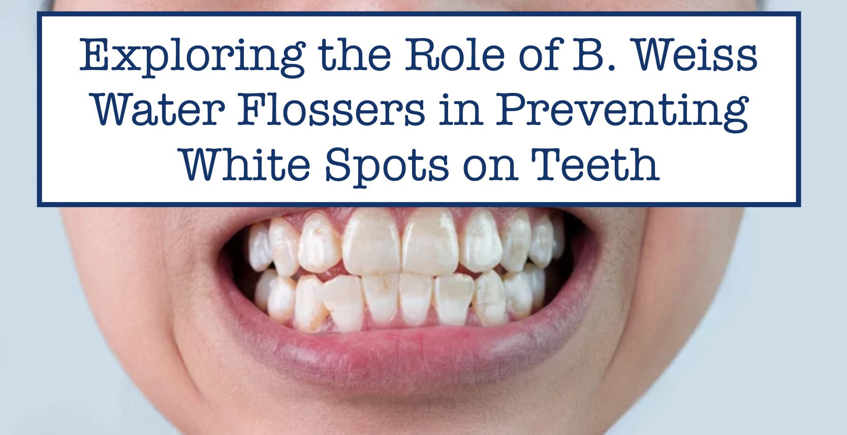 Exploring the Role of B. Weiss Water Flossers in Preventing White Spots on Teeth