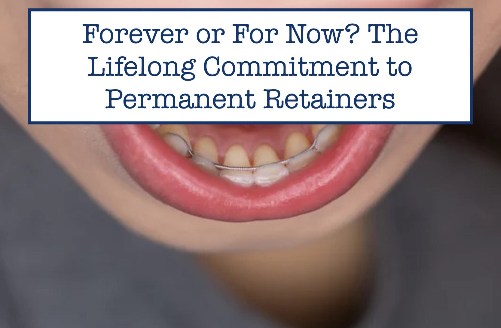 Forever or For Now? The Lifelong Commitment to Permanent Retainers