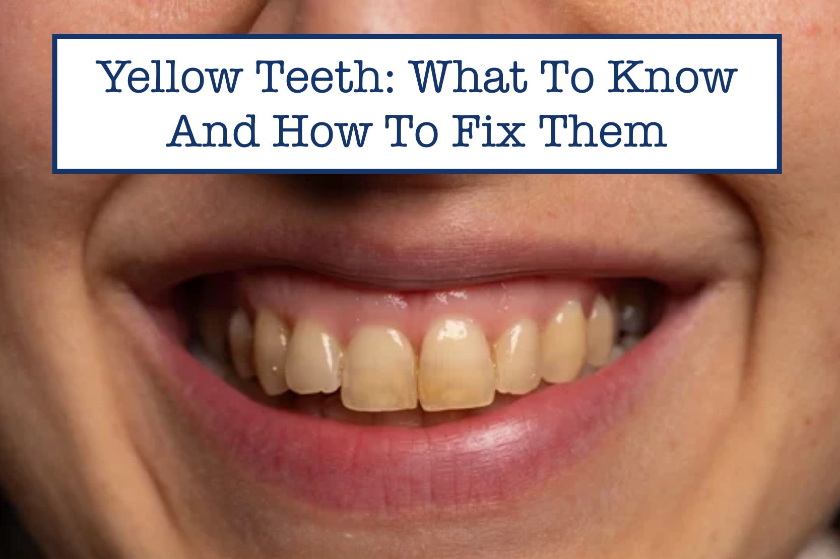 Yellow Teeth: What To Know And How To Fix Them