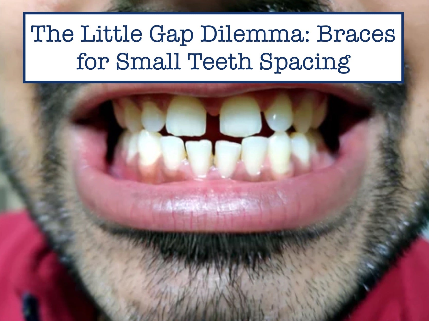 The Little Gap Dilemma: Braces for Small Teeth Spacing