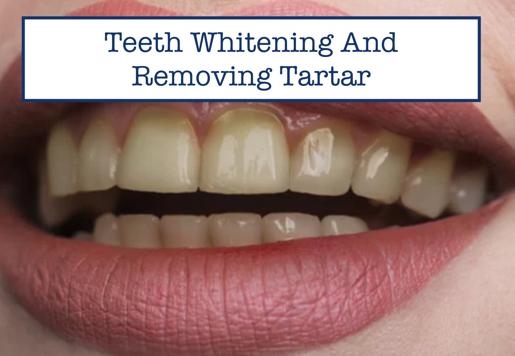 Teeth Whitening And Removing Tartar