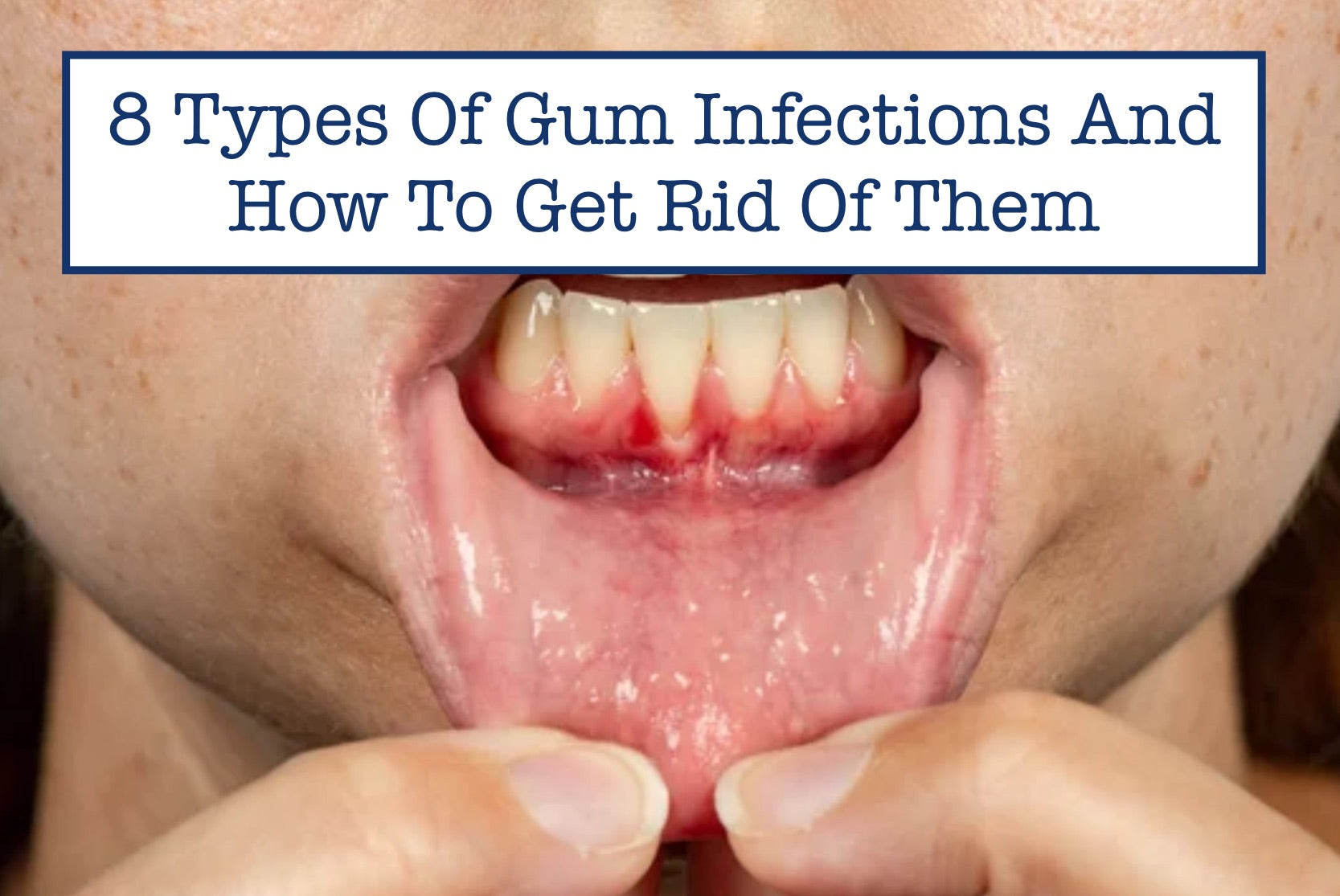 8 Types Of Gum Infections And How To Get Rid Of Them