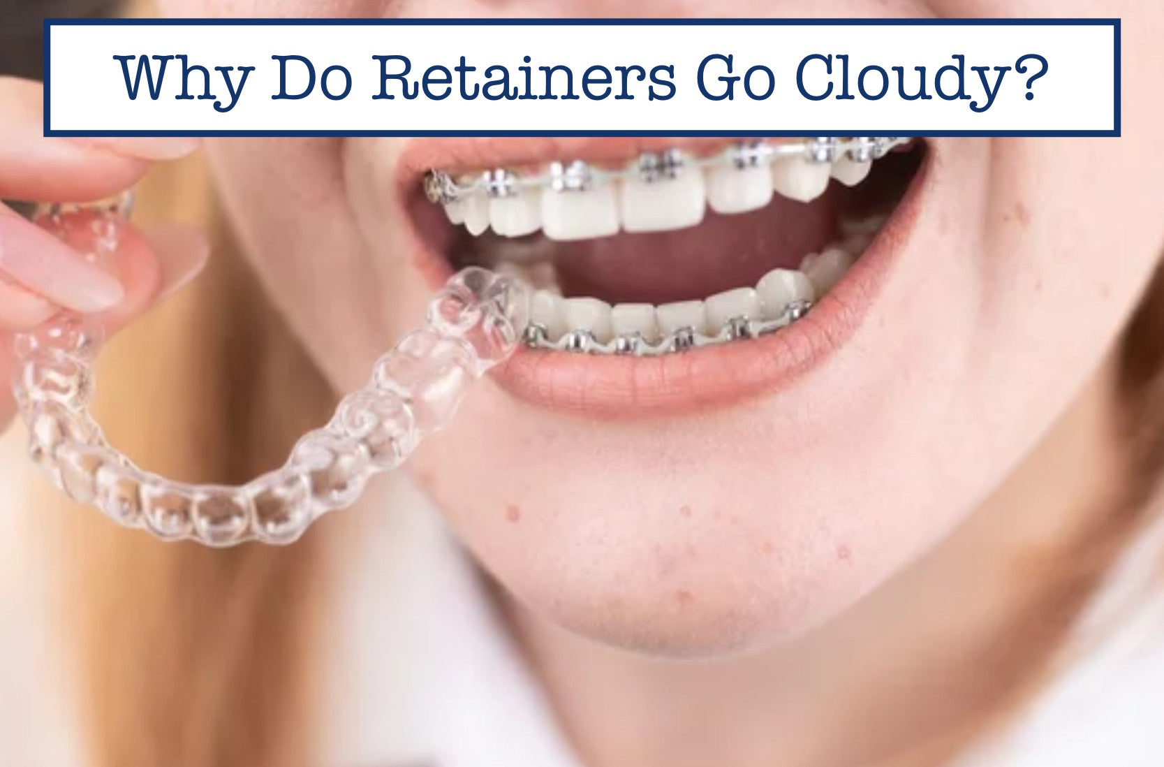 Why Do Retainers Go Cloudy?