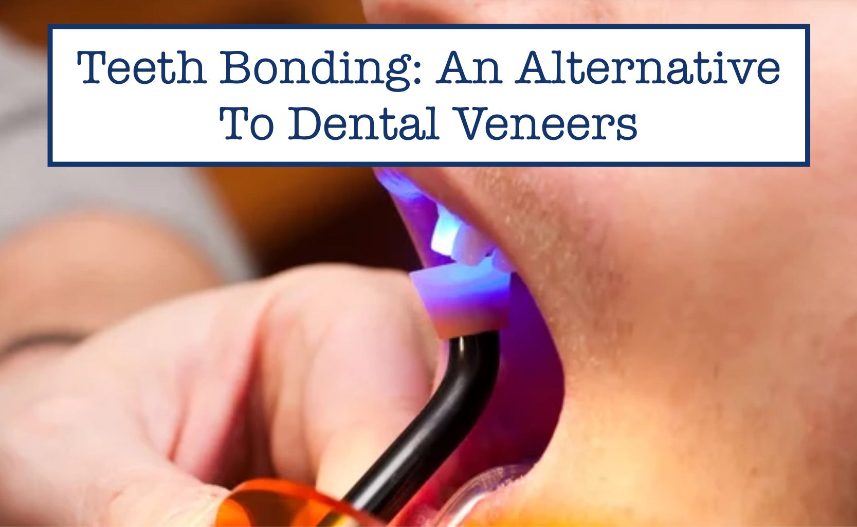 Teeth Bonding: An Alternative To Dental Veneers