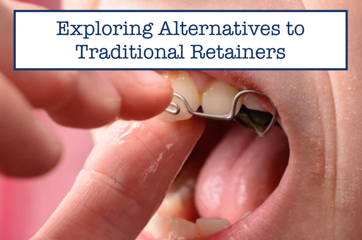 4 Innovative Alternatives to Traditional Retainers