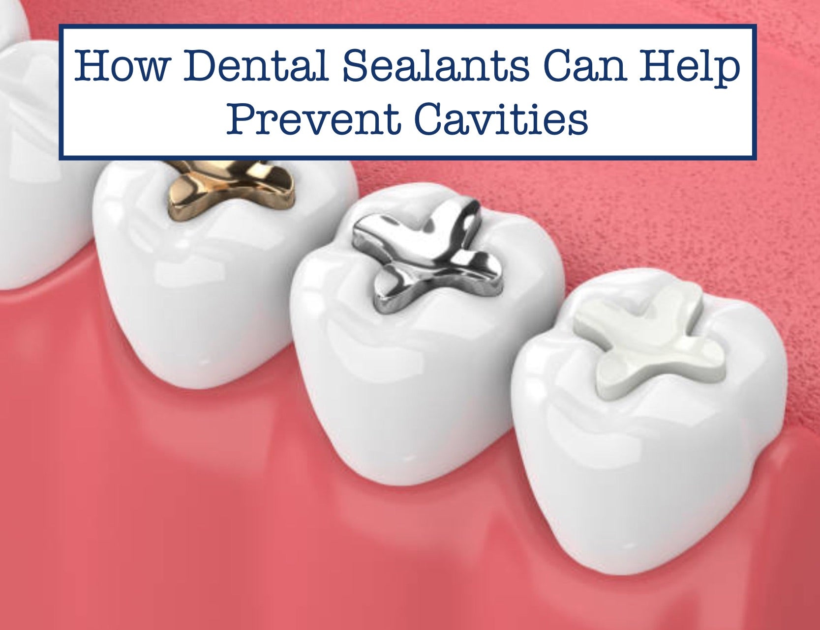How Dental Sealants Can Help Prevent Cavities?