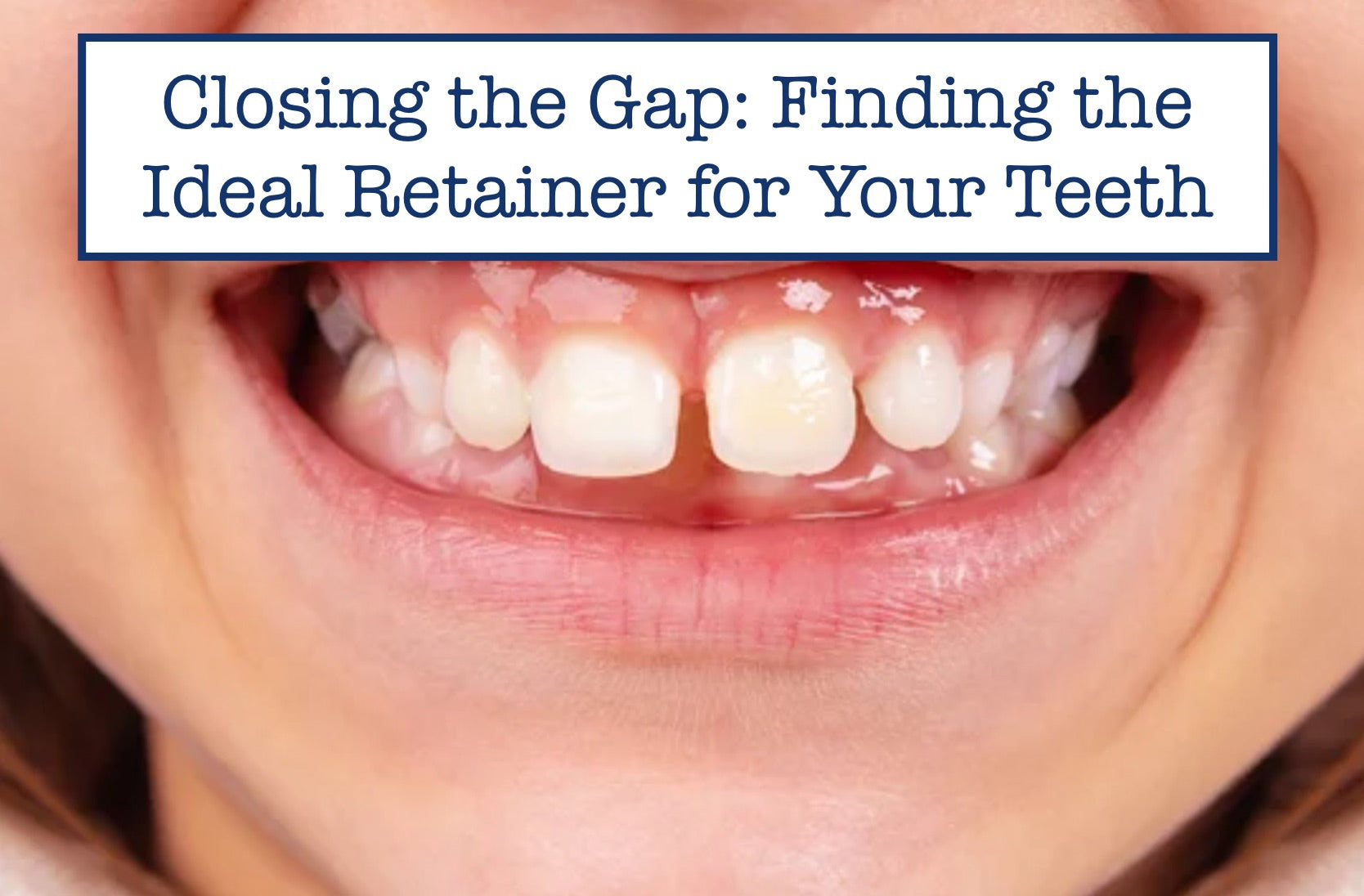 Closing the Gap Finding the Ideal Retainer for Your Teeth