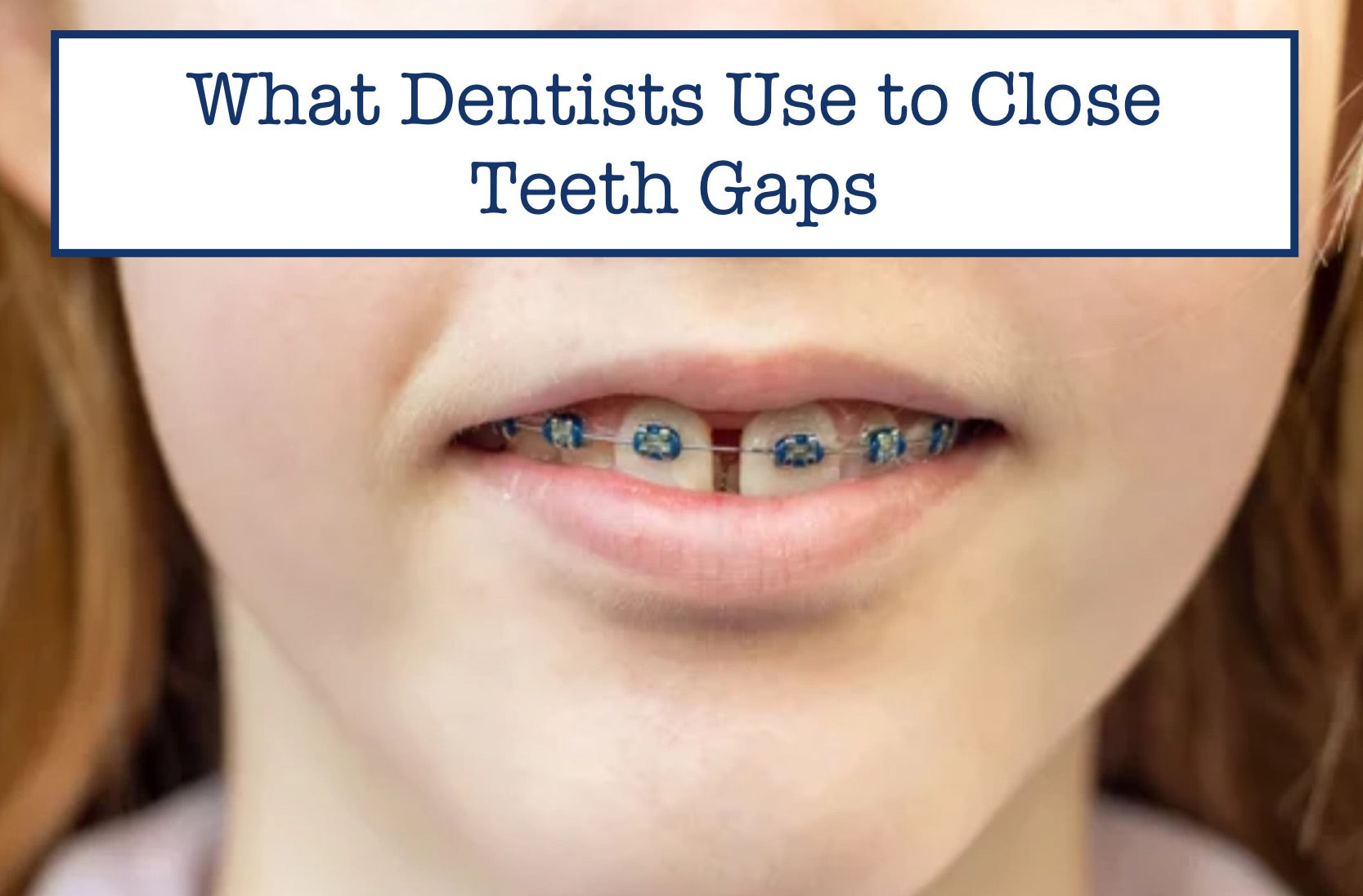 Close Teeth What Dentists Use to Close Teeth Gaps – B.WEISS Health