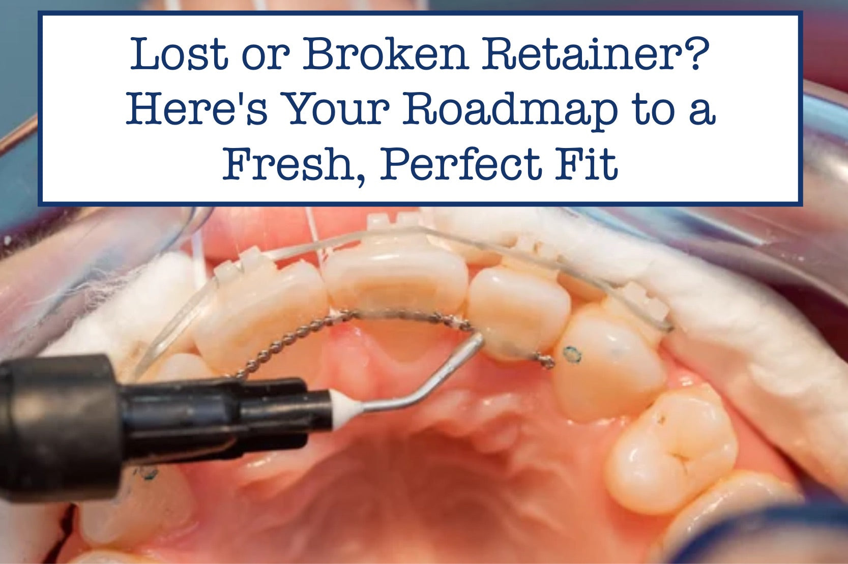 Lost or Broken Retainer? Here's Your Roadmap to a Fresh, Perfect Fit