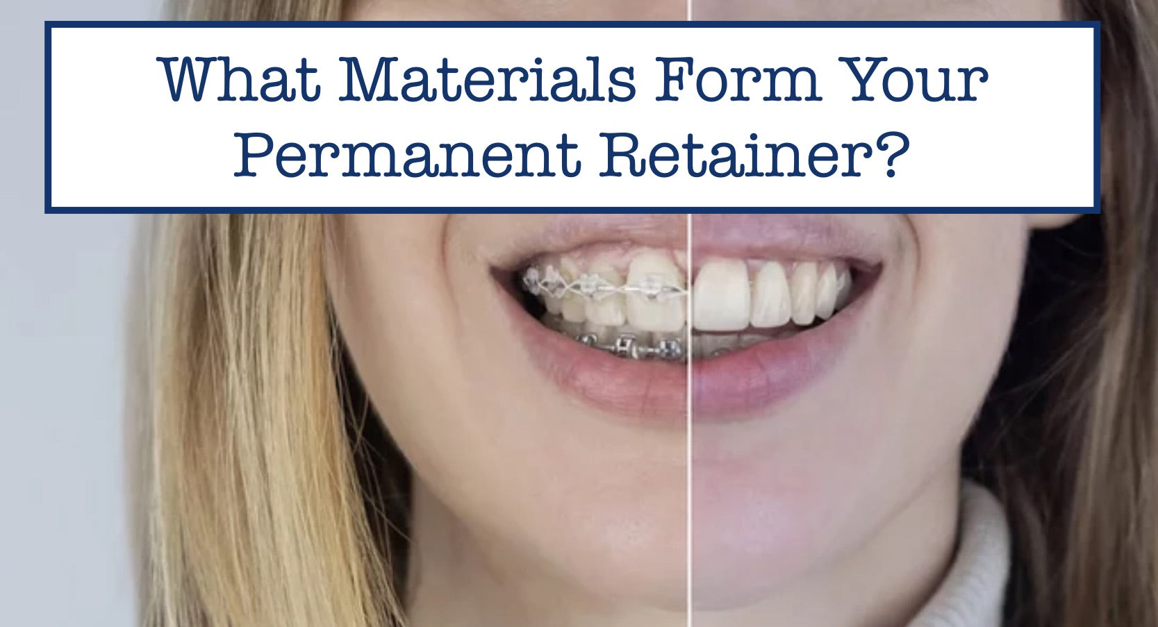 What Materials Form Your Permanent Retainer?
