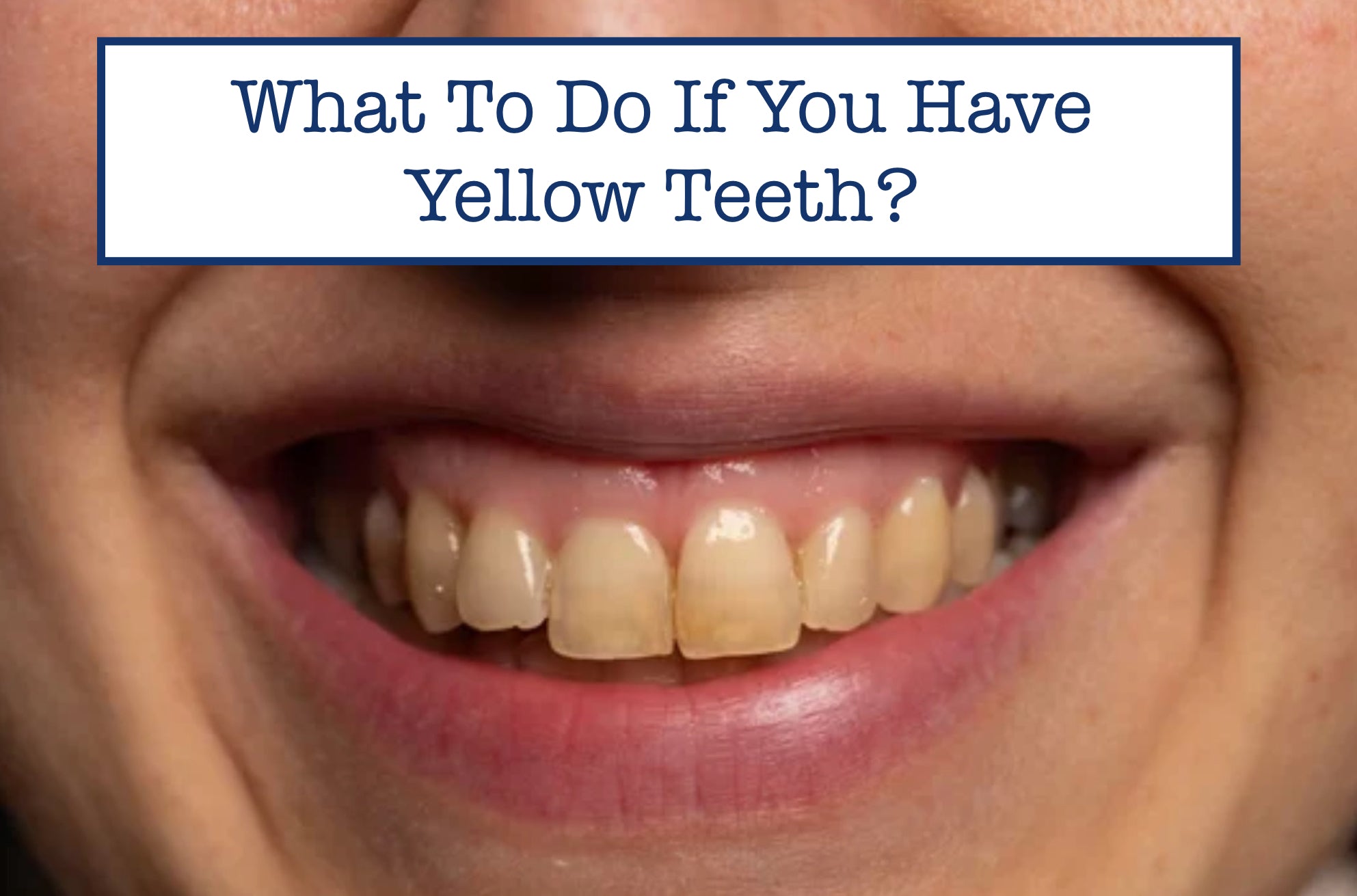 What To Do If You Have Yellow Teeth?
