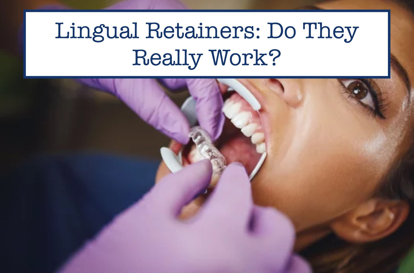 Lingual Retainers: Do They Really Work?