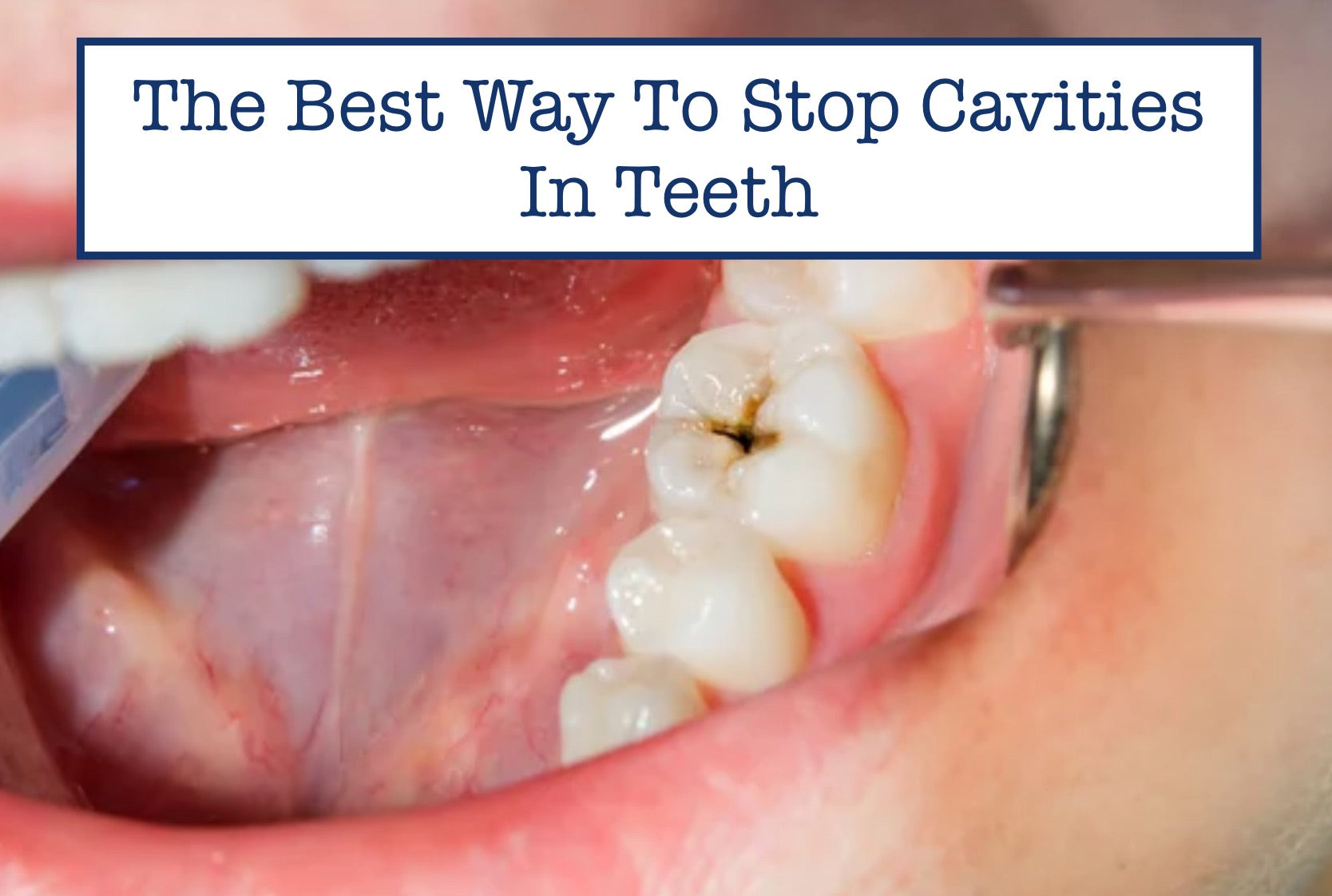 The Best Way To Stop Cavities In Teeth