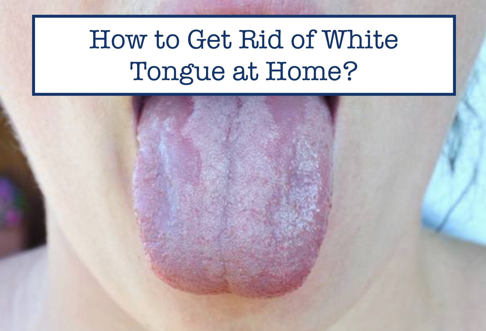 How to Get Rid of White Tongue at Home