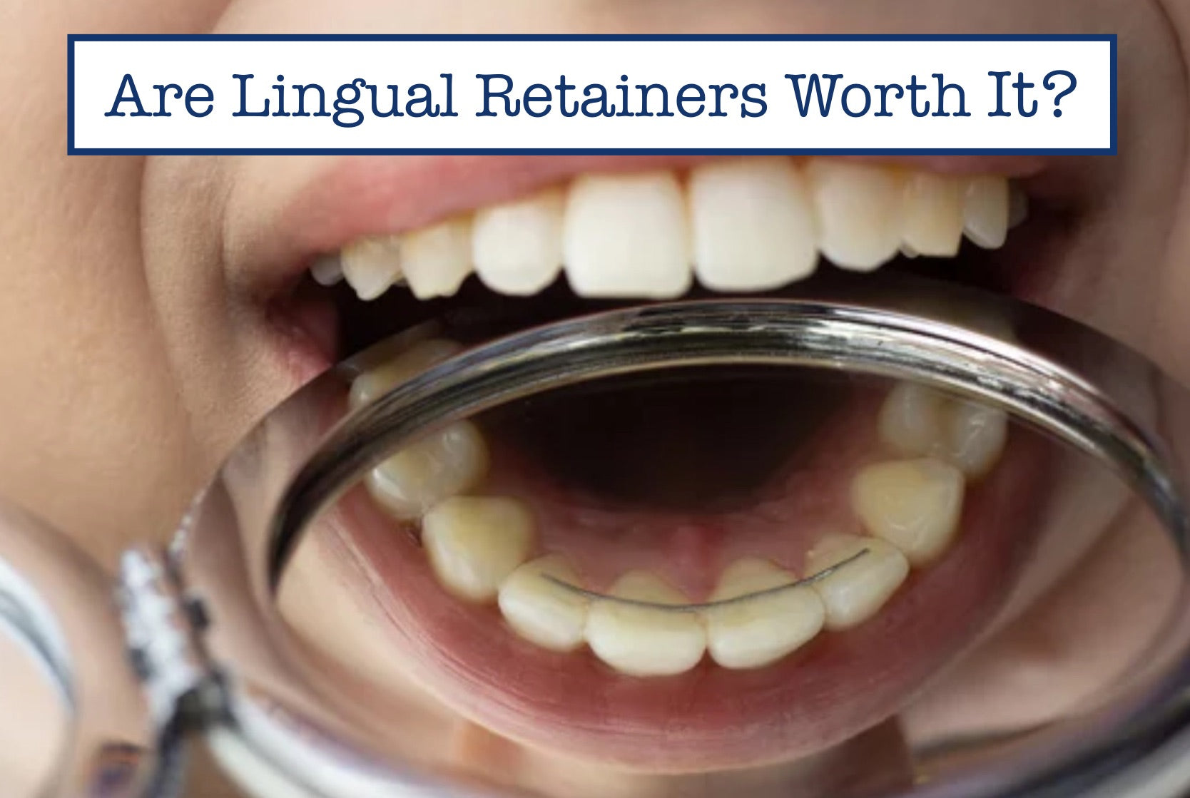 Are Lingual Retainers Worth It?