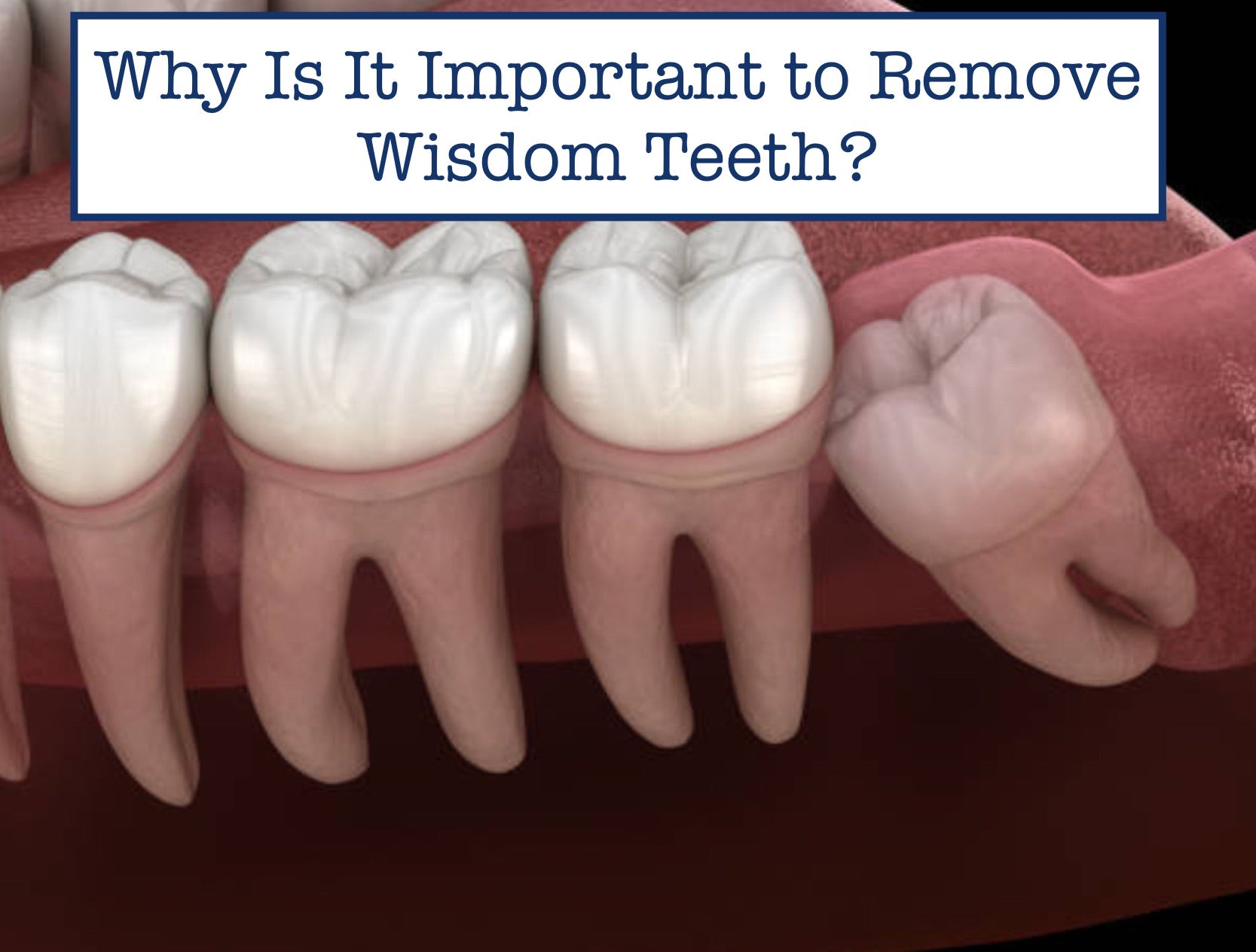 Why Is It Important to Remove Wisdom Teeth?
