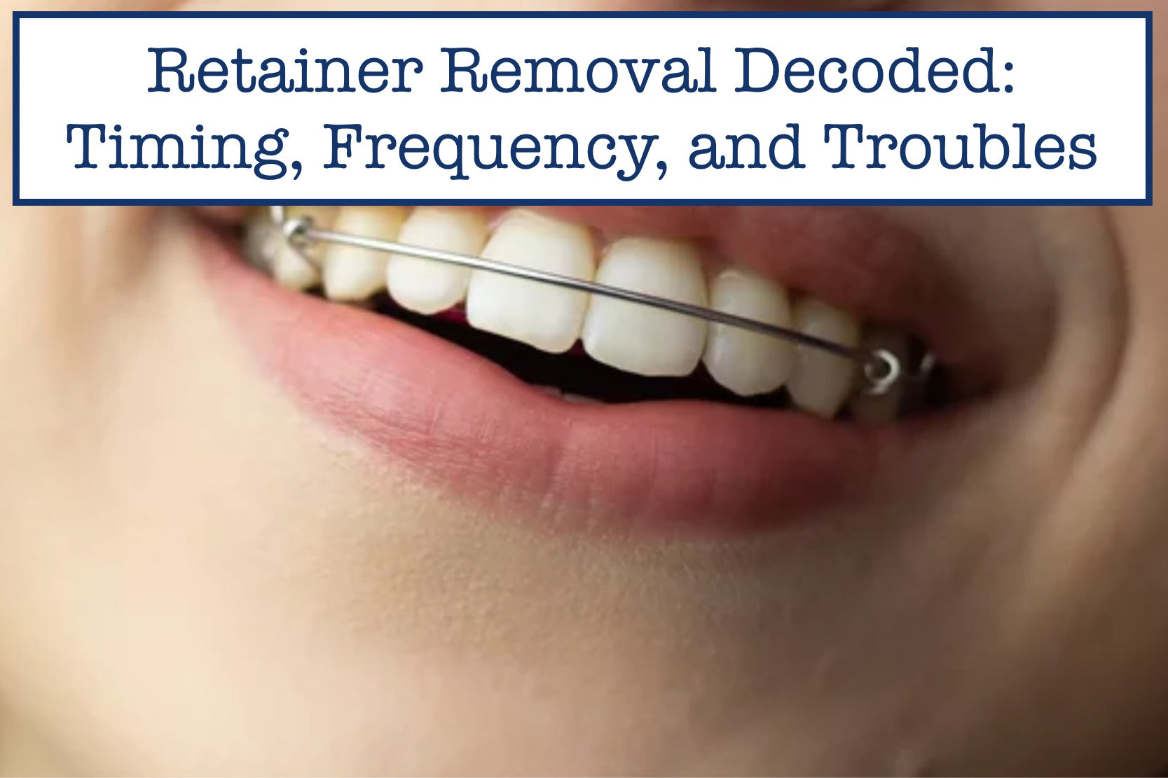 Retainer Removal Decoded: Timing, Frequency, and Troubles – B.WEISS Health