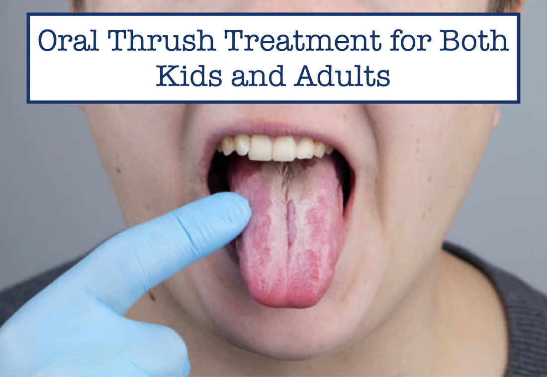 Oral Thrush Treatment for Both Kids and Adults