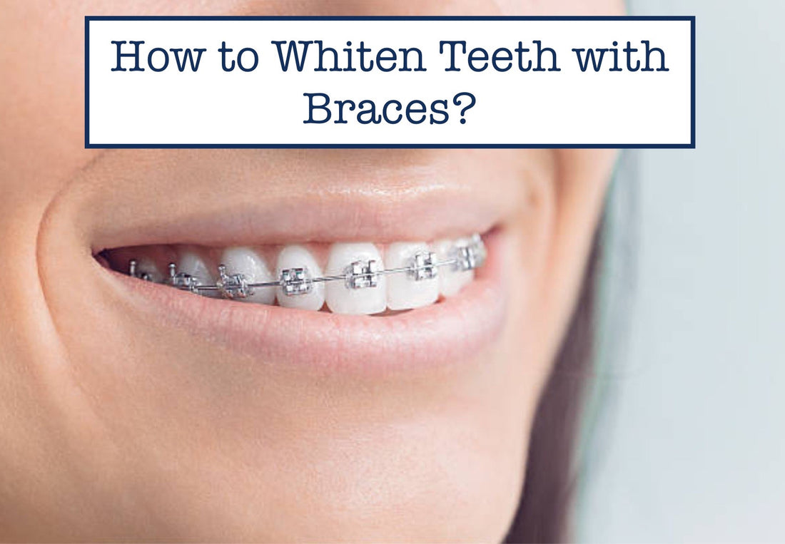 How to Whiten Teeth with Braces