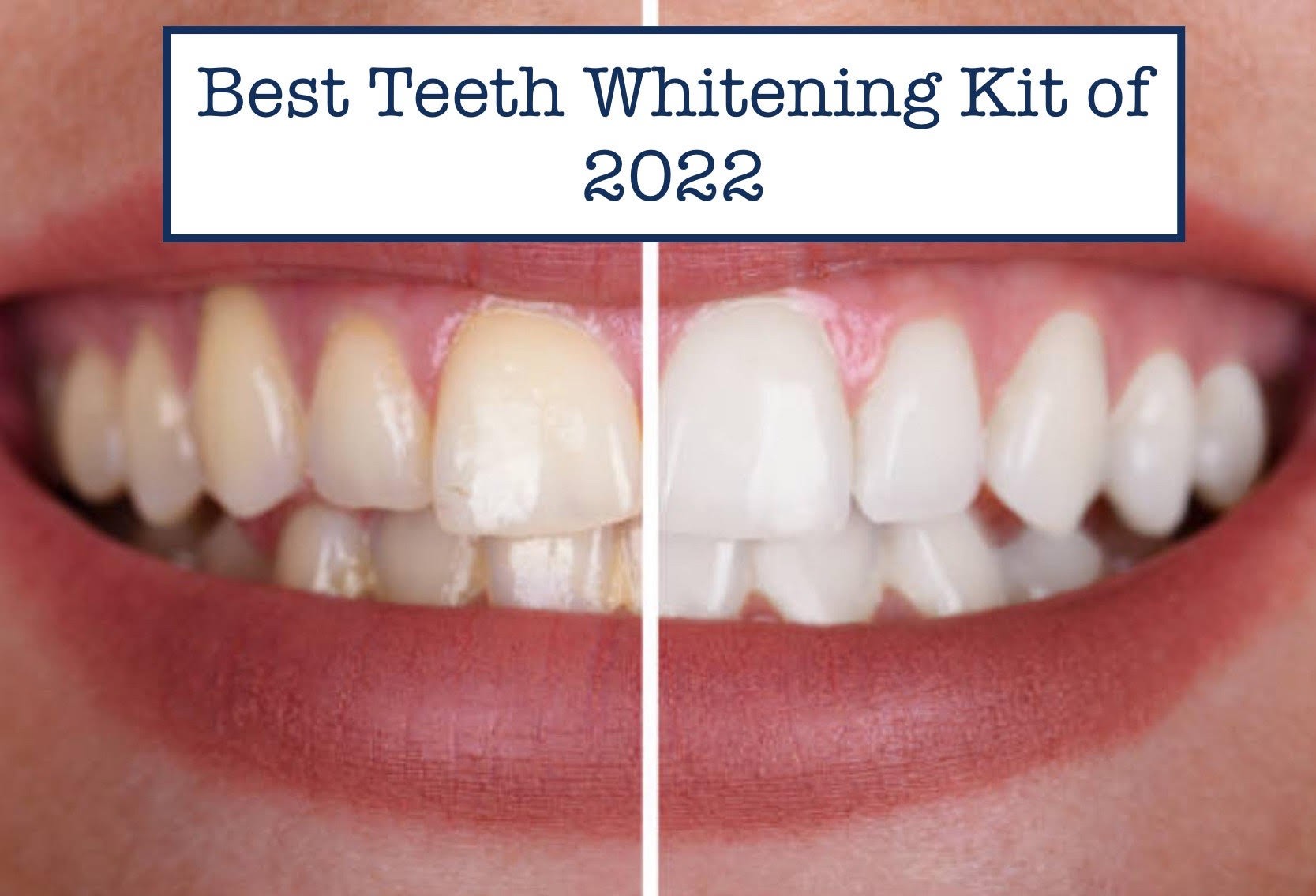 Best Teeth Whitening Kit of 2022
