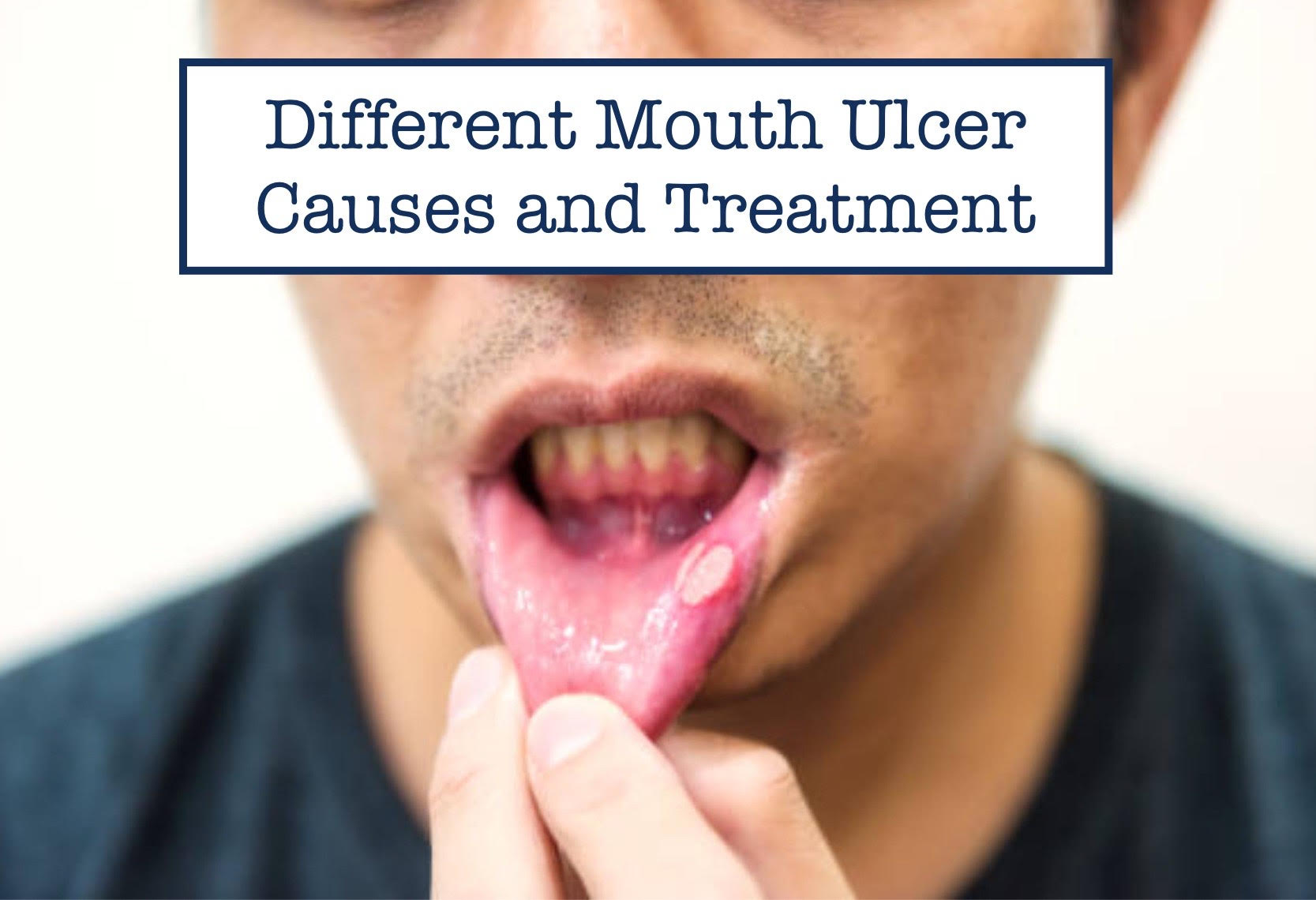 Different Mouth Ulcer Causes and Treatment 