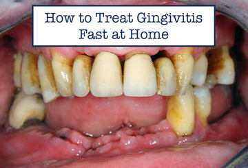 How to Treat Gingivitis Fast at Home